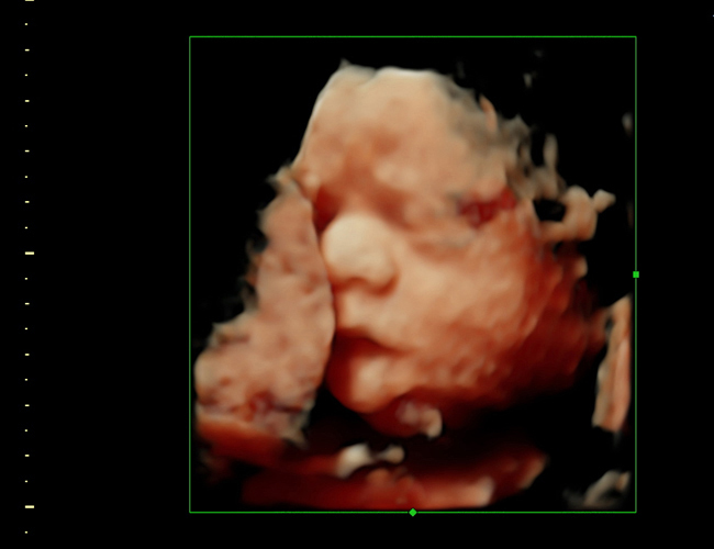 3D ultrasound image at 28 weeks
